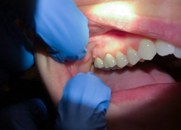 Best Emergency Root Canal Treatment in Leesport, PA